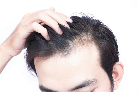 Iron Deficiency and Hair Loss: How To Deal With It?