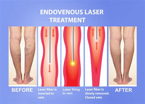 Varicose Veins and laser - UDAI OMNI HOSPITAL