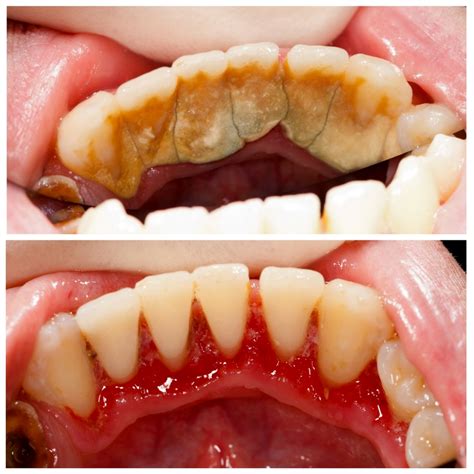 Dental teeth cleaning & Debridement Before & After photos