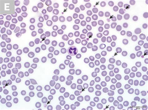 Blood Smear Platelet Evaluation & Interpretation | Clinician's Brief