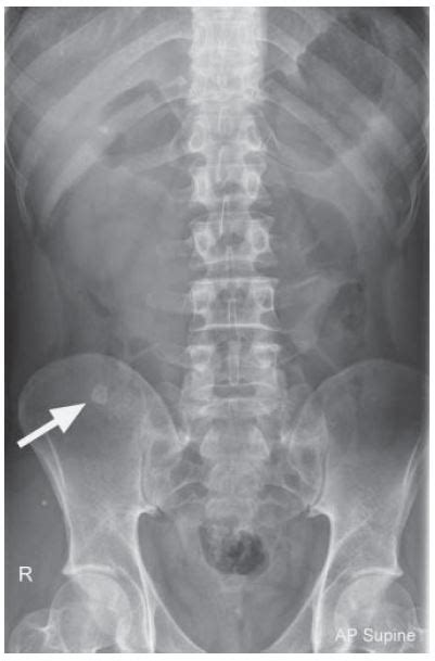 Appendicitis - Xray, Ultrasound and CT scan - RadTechOnDuty