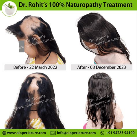 ophiasis alopecia areata treatment