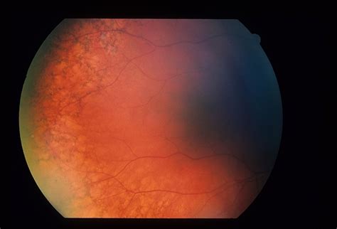 RPE Reticular Degeneration - Retina Image Bank