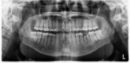Dental caries | Radiology Reference Article | Radiopaedia.org