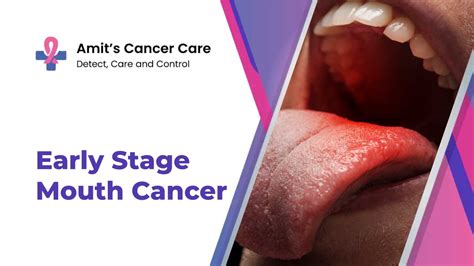 The Early Stage of Cheek Mouth Cancer | Symptoms & Treatments