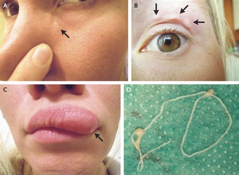 Migrating Dirofilaria repens | NEJM