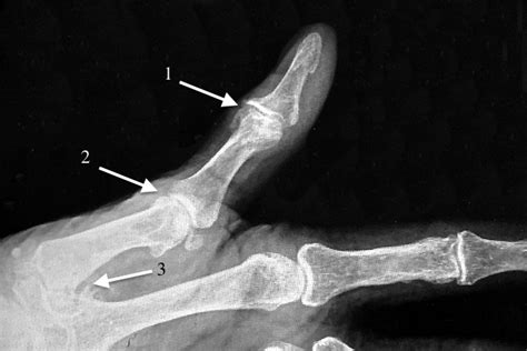 OSTEOARTHRITIS FINGER/THUMB (MP, PIP, DIP & IP) | Hand Surgery Source