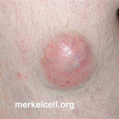 Clinical Photos of Merkel Cell Carcinoma | Merkel Cell Carcinoma