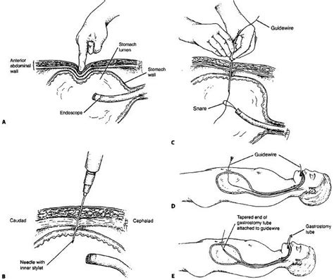 A. The procedure for percutaneous endoscopic gastrostomy includes transillumination of the ...