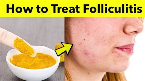 How to Treat Folliculitis at Home - Best Folliculitis Treatment at Home ...