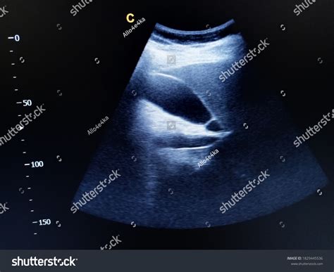 Septum Gallbladder By Ultrasound Stock Photo 1829445536 | Shutterstock