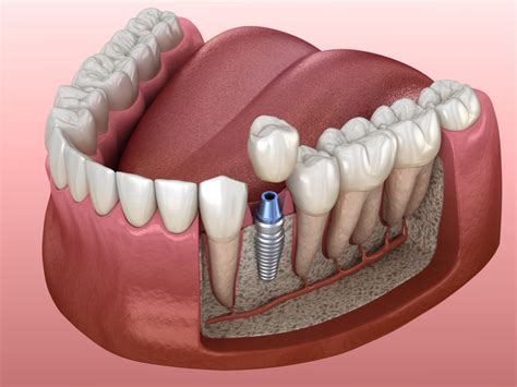 Are dental implants an option if you have severe bone loss?