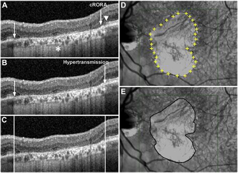 Quantification of Geographic Atrophy Using Spectral Domain OCT in Age-Related Macular ...