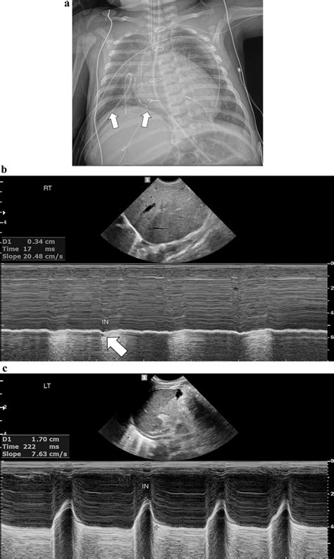 Paradoxical motion in diaphragmatic paralysis in an 8-week-old boy... | Download Scientific Diagram