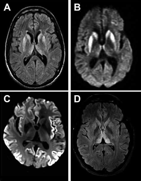 Creutzfeldt-Jakob disease (CJD) - (A & B) Sporadic CJD showing ...