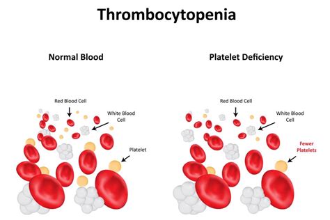 What is Thrombocytopenia?