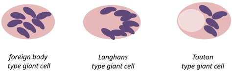 32. Granuloma. Granulomatous inflammation – greek.doctor