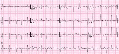 Dr. Smith's ECG Blog: Atrial fibrillation? Multifocal Atrial ...