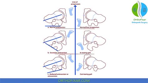 Femoral Anteversion | OrthoFixar 2024