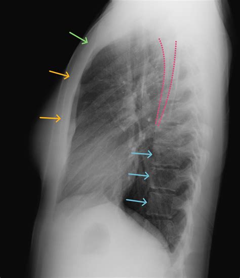 Chest X-Ray Anatomy | CaseStacks.com