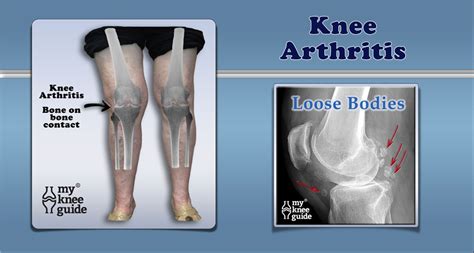 Symptomatic osteoarthritis of the knee occurs in 6% of adults over the age of 30 and in 12% of ...