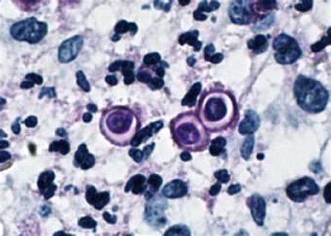 Blastomycosis Histology