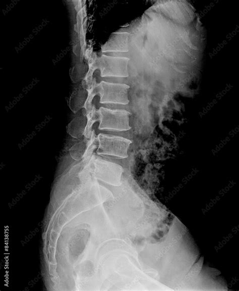 Lumbar Vertebrae Anatomy Xray