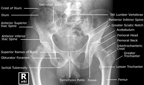 Radiographic Anatomy - Pelvis AP Male Radiology Schools, Radiology Student, Radiology Technician ...