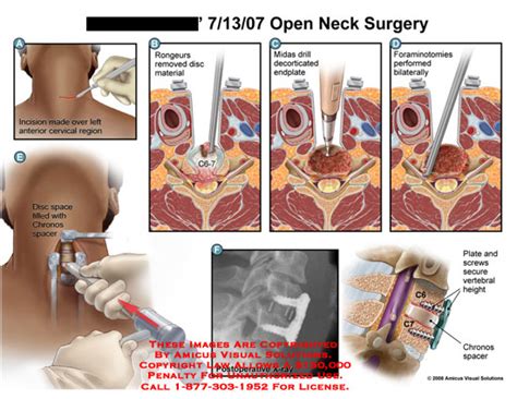 AMICUS Illustration of amicus,surgery,neck,cervical,open,incision,discectomy,diskectomy ...