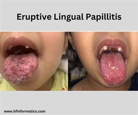 Clinical Features of TransientLinguam Papillitis: