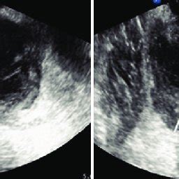 Prostate ultrasound showing abscess. | Download Scientific Diagram