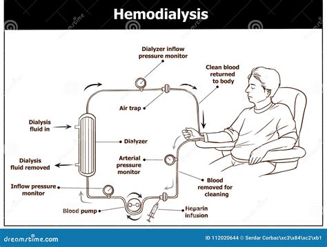 Hemodialysis Procedure. Used for the Renal Insufficiency. Stock Vector ...