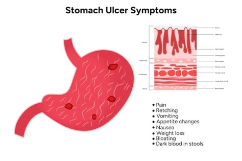 Premium Vector | Stomach Ulcer symptoms peptic ulcer