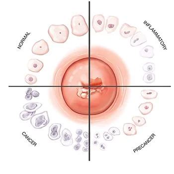 Abnormal Pap Smear Treatment | Best Gynecologists in NYC