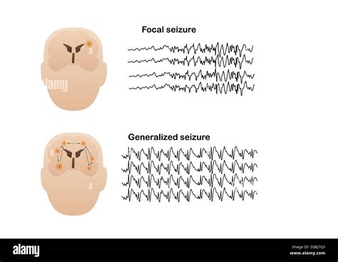 Vector illustration of seizure types demonstrating by onset and brain waves. Focal seizure and ...