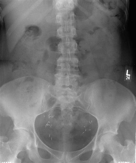 Ap Lumbar Spine Xray