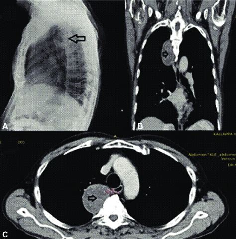 Neurogenic tumor. Lateral radiograph (A) demonstrating a lesion in the ...