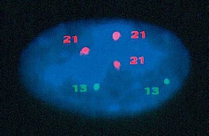 A-1-3 Les anomalies de caryotype - Sciences de la vie et de la Terre