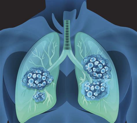 Immunotheapy In Lung Cancer | Millennium Cancer Center