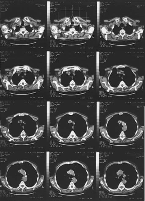 How To Read Chest Ct Scan at Theresa Bengtson blog