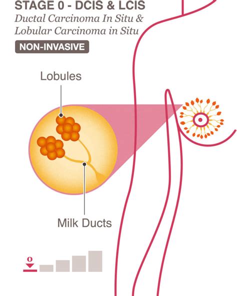 Invasive Ductal Carcinoma Diagram