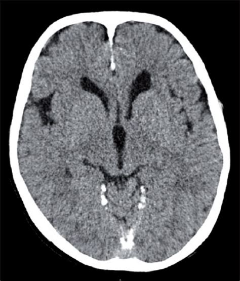 CT, axial view showing calcification of falx cerebri | Download Scientific Diagram