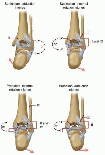 Open Reduction and Internal Fixation of the Ankle | Musculoskeletal Key