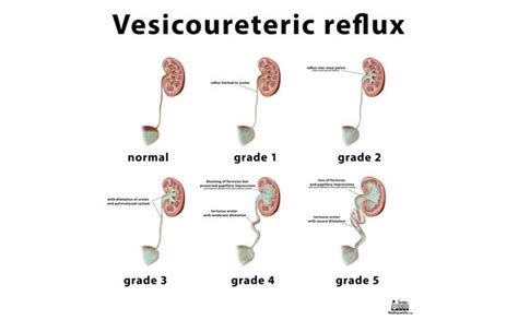 Vesicoureteric Junction Calculus Treatment | Symptoms