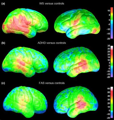 ADHD Brain Differences » Stuff4Educators.com