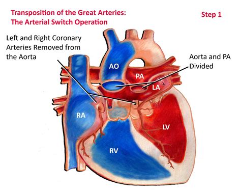 Transposition of the Great Arteries - Surgical Repair - Pediatric Heart Specialists