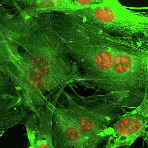 Microscopic image of fusion of cell nuclei in breast cancer cells ...