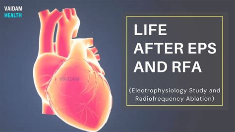 EPS RF Ablation- Frequently Asked Questions, 60% OFF