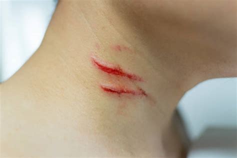 Cuts And Bruises Stock Photos, Pictures & Royalty-Free Images - iStock