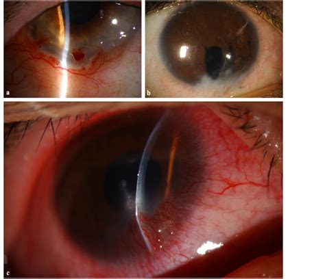 Phlyctenulosis-Like Presentation Secondary to Embedded Corneal Foreign Body